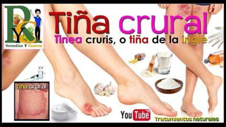Tiña crural
