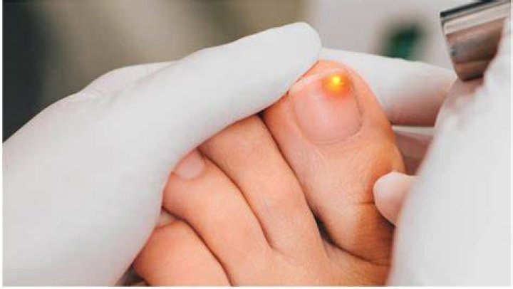Toenail Fungus Laser Doctor Kansas City – KC Foot Care