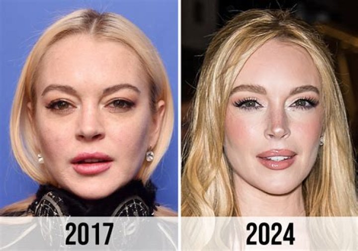 Uncover The Truth Behind Lindsay Lohan's Cosmetic Surgery Journey