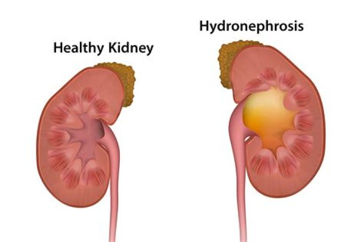 Unilateral hydronephrosis