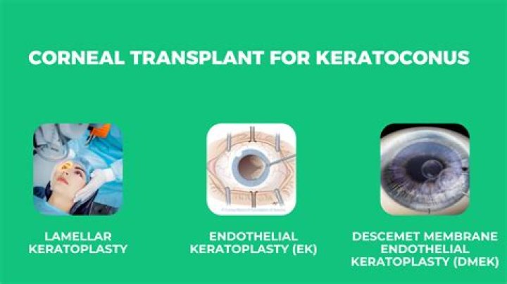 Unveiling The Breakthroughs Of Dinh Bowman: Innovations Transforming Corneal Transplants