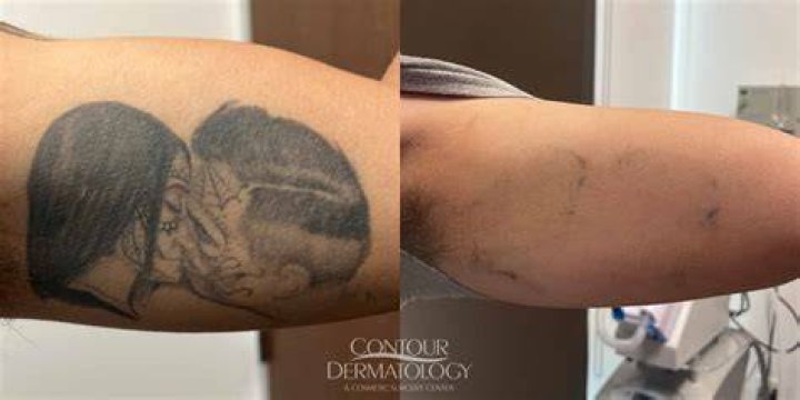Unveiling The Optimal Window For Tattoos Before Surgery