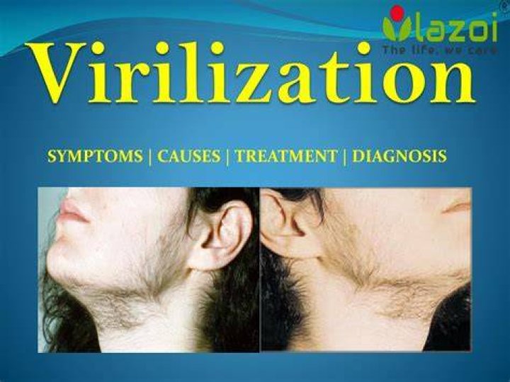 Virilization