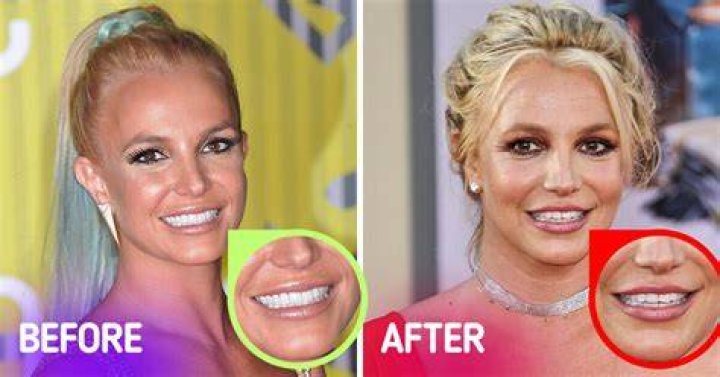 What Happened To Britney Spears' Teeth: A Journey Of Transformation